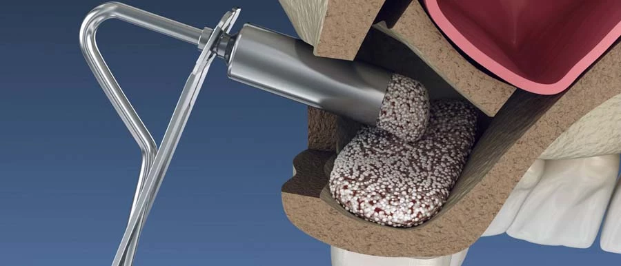 Bone replacement sinus lift