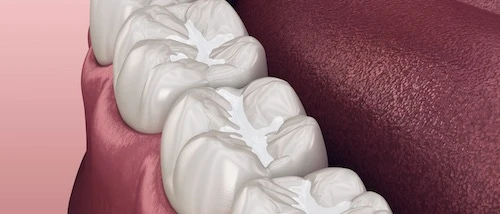 Creation of fissure sealing