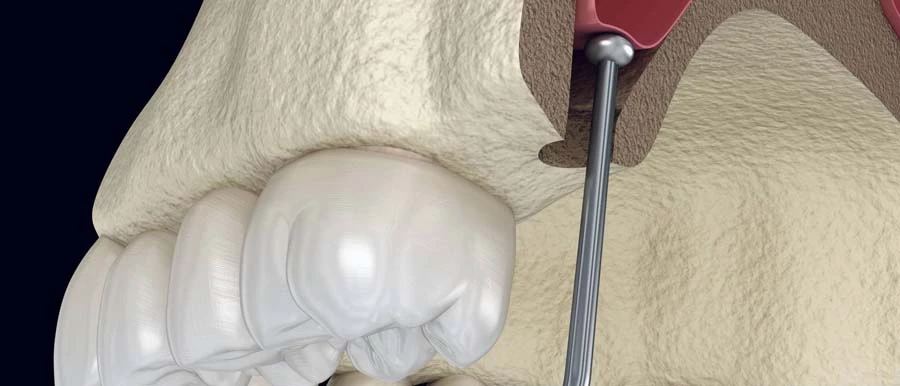 Belső arcüreg emelés