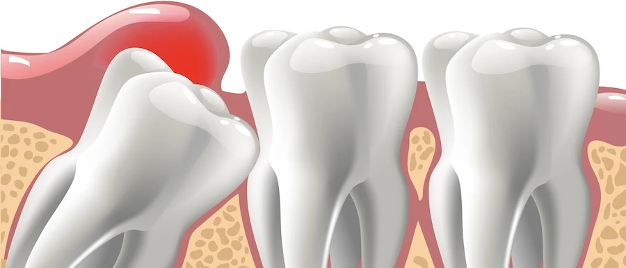 Bölcsességfog gyulladás