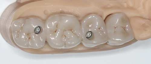 Screw-based tooth implantation