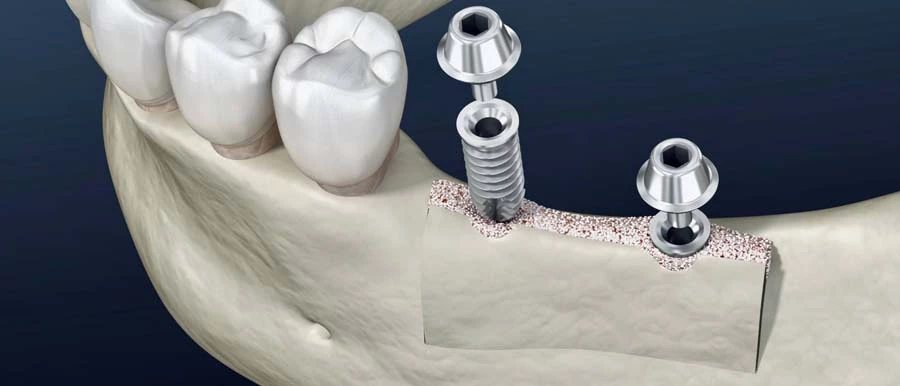 Bone replacement tooth replacement