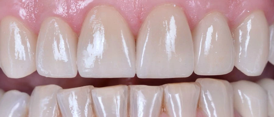 Aesthetic metal-free crown