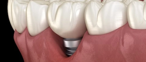 Pain after implant