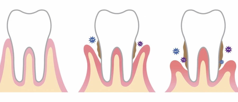 Process of gum disease