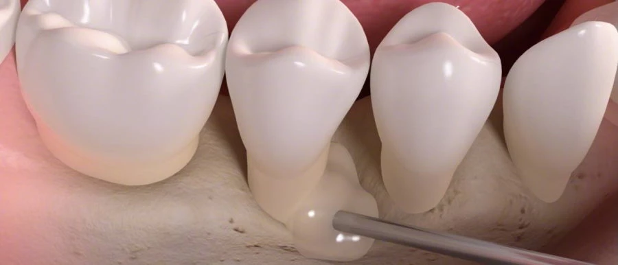 Gum disease regenerative therapy