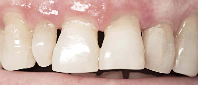 Gum disease, gum recession