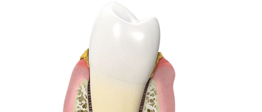 Tartar removal, treatment of gum inflammation