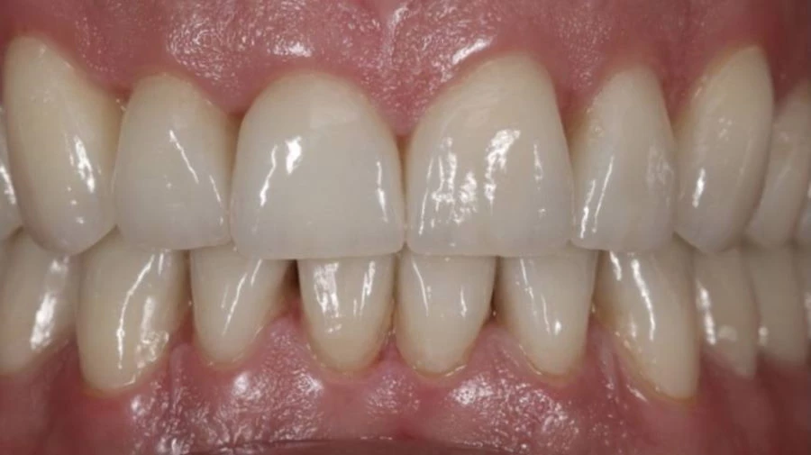 Aesthetic tooth replacement