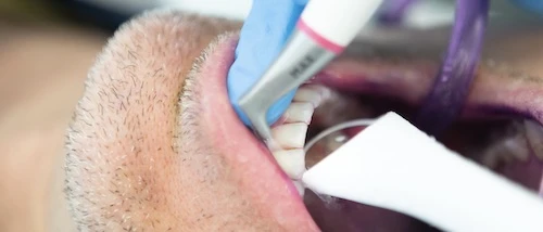 Guided Biofilm Therapy