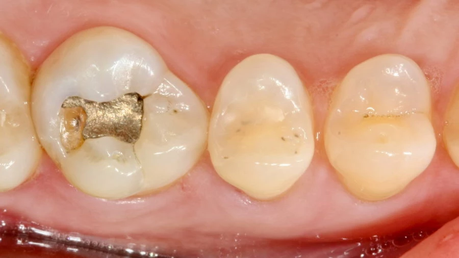 Amalgam filling