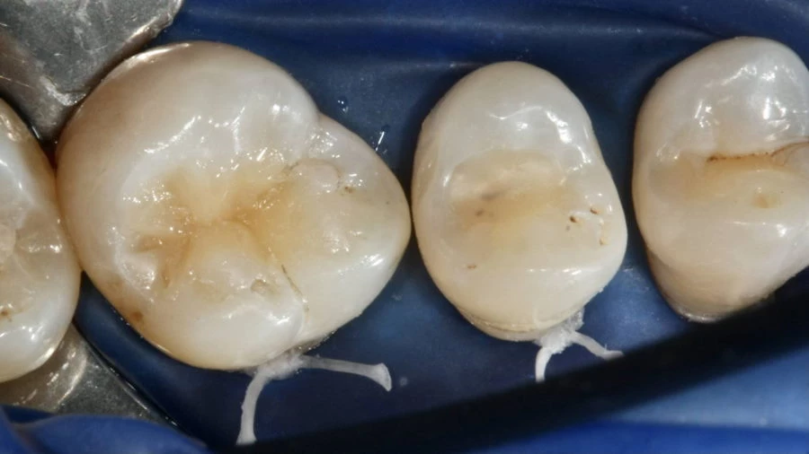 Steps of tooth filling