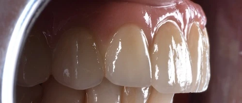 Implant based prosthesis