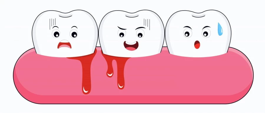 Bleeding gums