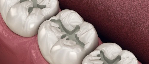 Extended fissure sealing