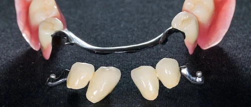 Picture of a clip-on denture