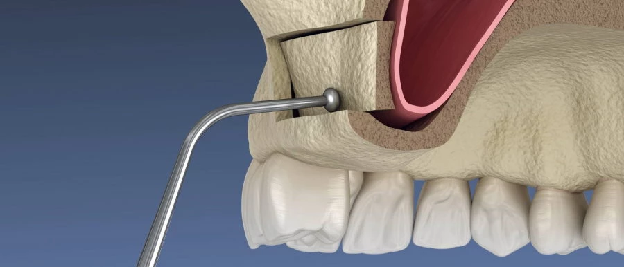 Külső arcüreg emelés
