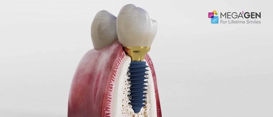 Megagen dental implantation