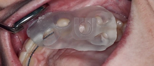 Megagen R2Gate surgical guide