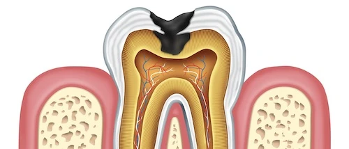 Why pain emerges after filling