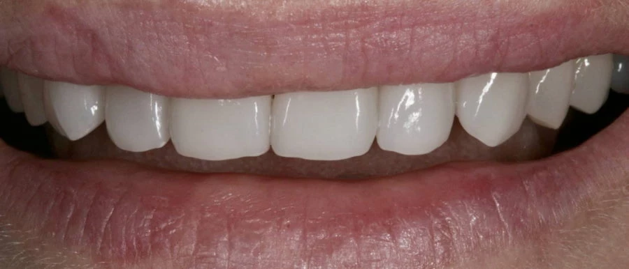 Veneers