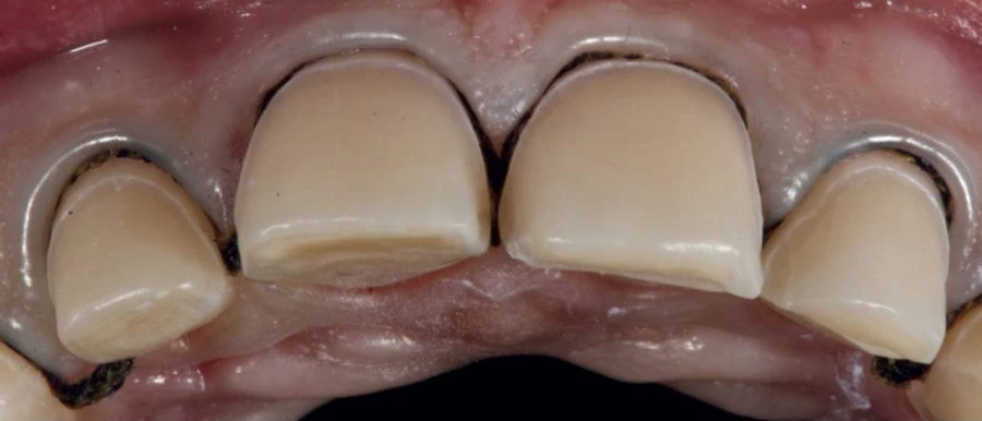 Image of a prepared tooth (veneer)