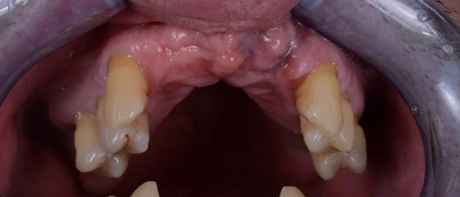 Multiple missing teeth