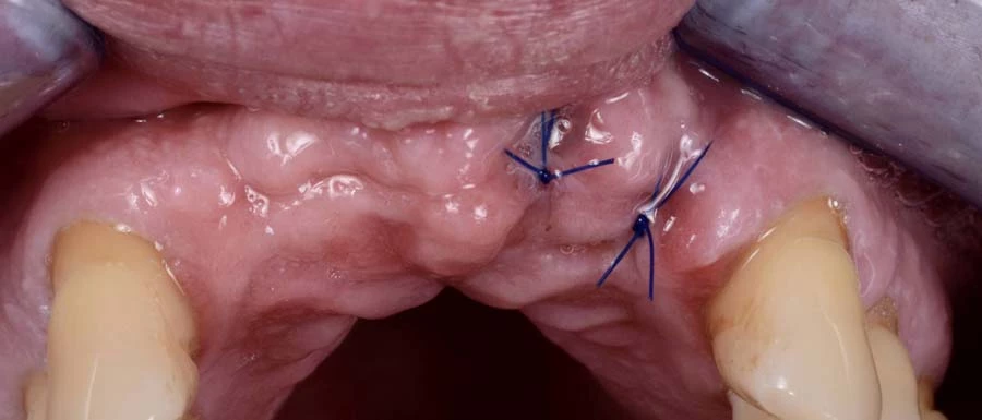 Foghúzás után varrat